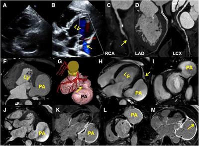 Case Report: A left ventricular pseudoaneurysm detected by cardiac magnetic resonance more than 1 year after a percutaneous transluminal coronary intervention